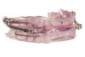 oral appliance for sleep apnea
