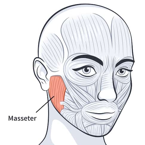 image of a head showing underlying facial muscles, highlighting the masseter muscle for botox injection
